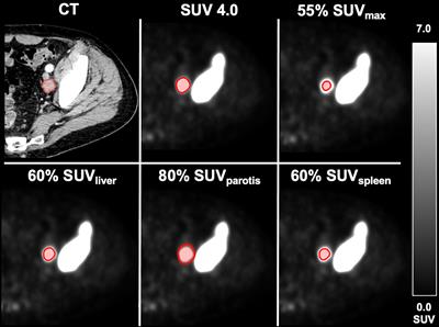 Feasibility of Different Tumor Delineation Approaches for 18F-PSMA-1007 PET/CT Imaging in Prostate Cancer Patients